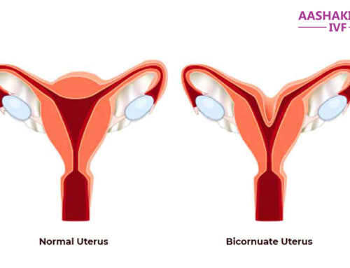 What is Bicornuate Uterus?